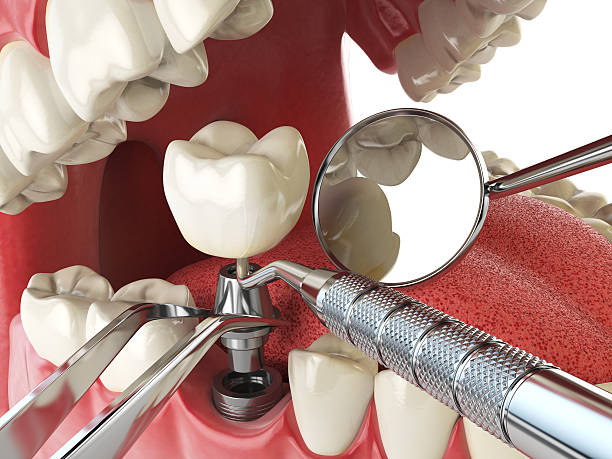 Best Emergency Dentist for Lost Fillings or Crowns in Lincolnia, VA